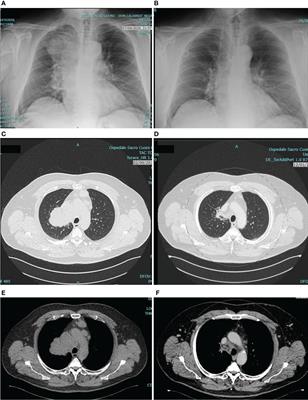 Chemo-immunotherapy for metastatic non-squamous NSCLC in a patient with HIV infection: A case report
